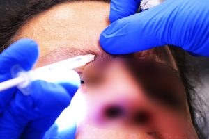 Lt. Col. Chester Barton, 374th Ear Nose and Throat Clinic otolaryngologist, administers Botox shots to Master Sgt. Danira Estrada, 374th Logistics Readiness Squadron section chief at Yokota Air Base, Japan, Feb. 16, 2017. Botox shots treat migraines by relaxing muscles that cause pain. Treating migraines is one of the many ways Yokota’s ENT clinic helps personnel keep doing their jobs happily and in good health. (U.S. Air Force photo by Senior AirmanElizabeth Baker)